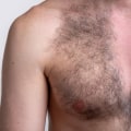 Are Laser Hair Removal Treatments Safe in the Long-Term? A Comprehensive Guide