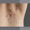 Can Laser Hair Removal Cause Infections? - An Expert's Perspective